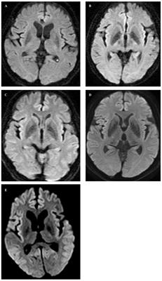 Dopaminergic neurodegeneration in Gerstmann–Sträussler–Scheinker (P102L) disease: insights from imaging and pathological examination